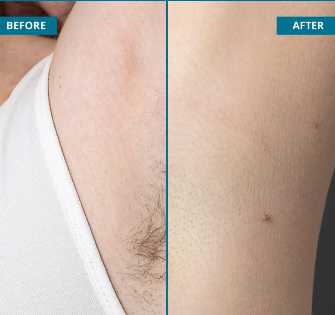 Underarms Hair Removal