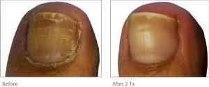 Close-up of a damaged toenail before and after treatment, showing improvement in nail health.