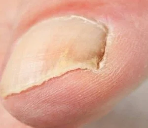 Close-up of a fingernail with peeling, damaged skin around the nail.