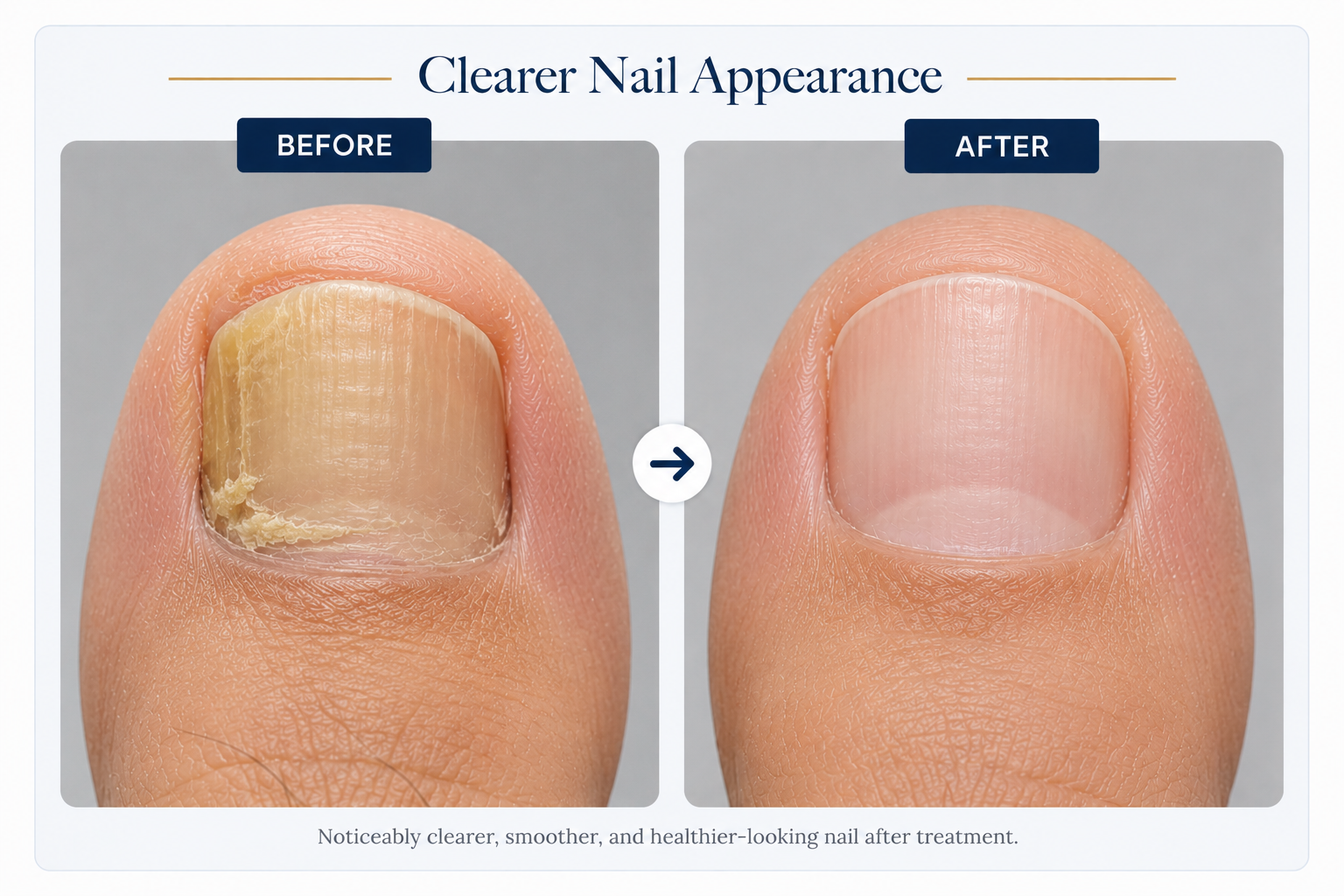 Comparison of a Toenail Before and After Fungal Treatment