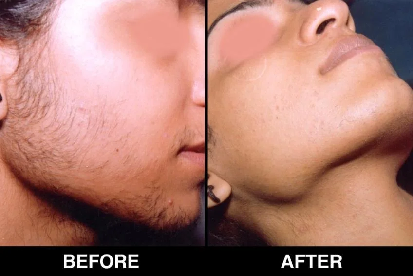 Facial Hair Removal