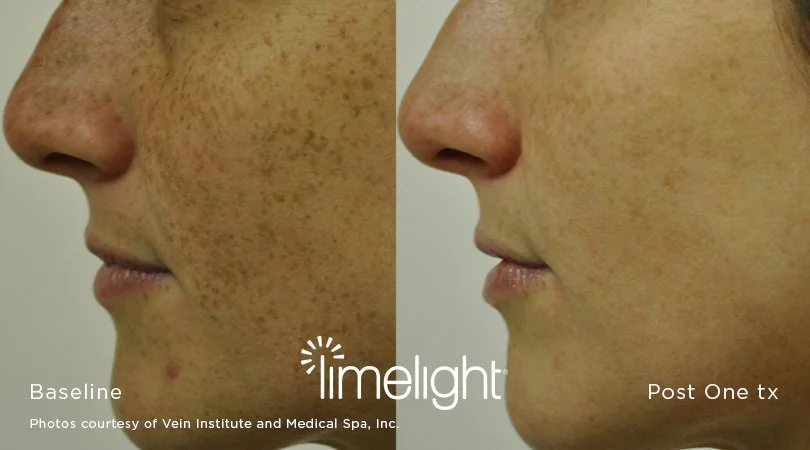 xeo_Limelight_3.jpg