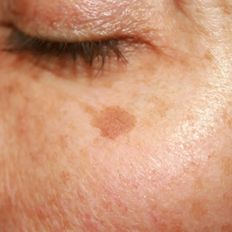 Close-up of a person’s cheek showing a brown age spot on the skin.