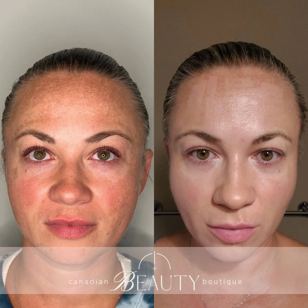 LimeLightI IPL Photofacial.jpeg