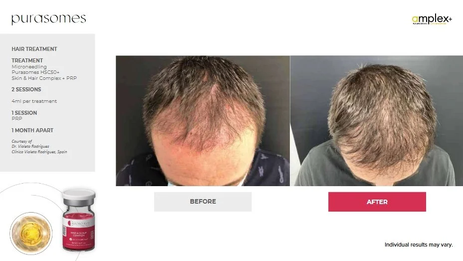 Hair treatment before and after comparison, featuring Pur-OSomes product and microneedling description.