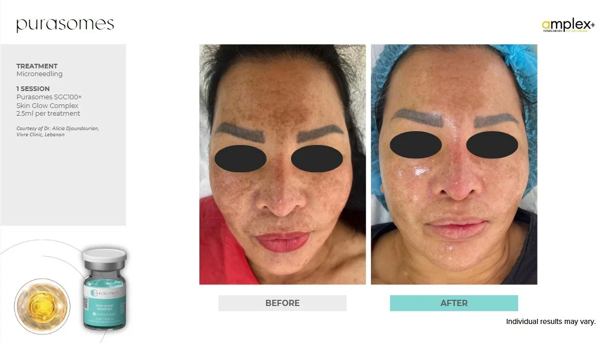 Before and after photos of a microneedling treatment using Purasomes SGC100+ Skin Glow Complex, showing improved skin texture.