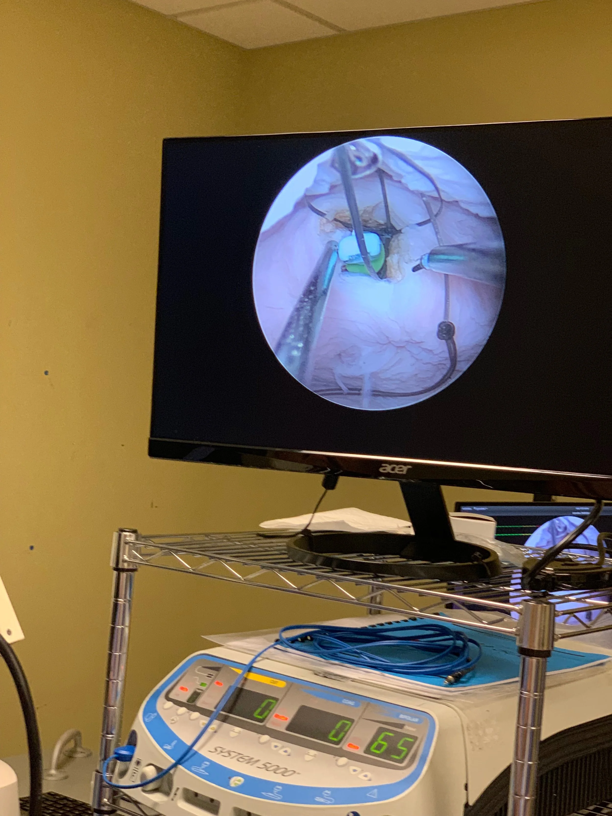 A Surgical Modeling Solutions real tissue model being used for a hysteroscopy