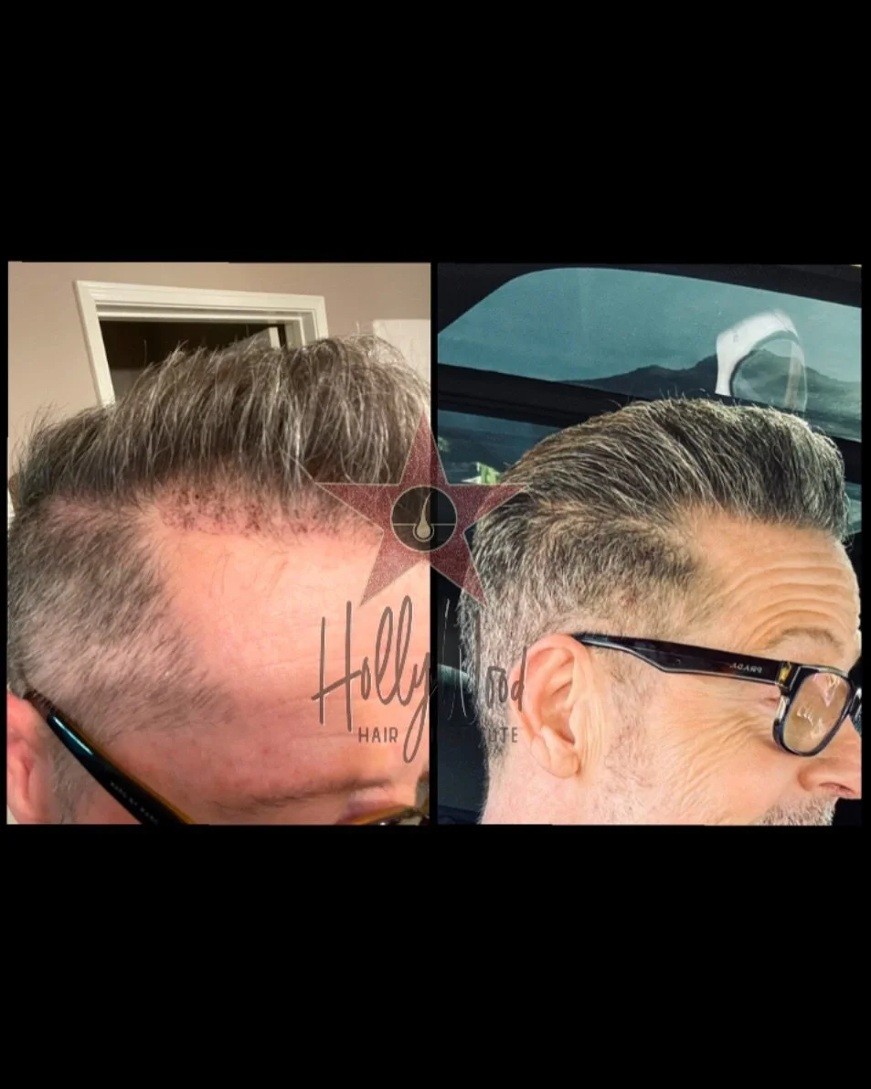 Best Hair Transplant Los Angeles – Hollywood Hair Institute