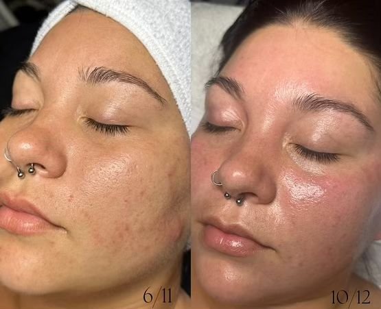 Look at this skin-progress! Consistency is key 👏🏽