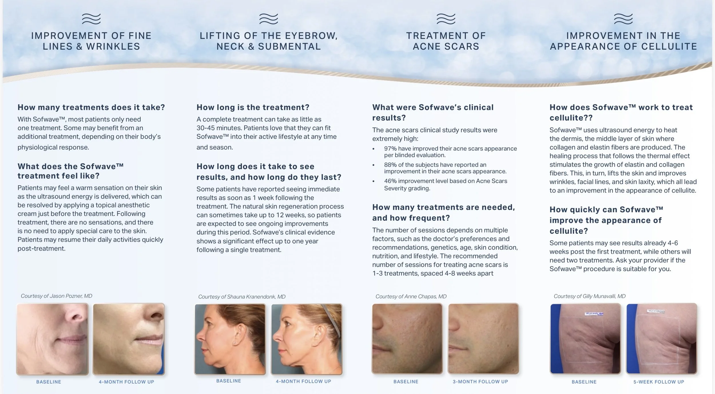 Informational brochure about Sofwave treatment for fine lines, wrinkles, eyebrow lifting, acne scars, and cellulite, with before and after photos and treatment details.