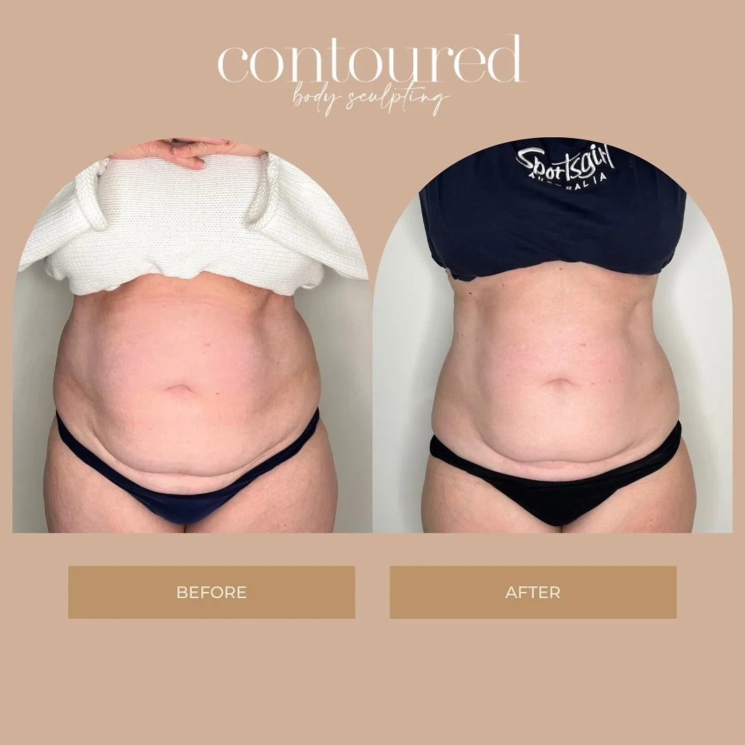 Abdomen Sculpt Results 🎉

Our client chose our 6 session Abdomen Sculpt package and just look at her results after the 6 sessions.

Our recommended treatment amount per area is 6-12 for best desired results. Our no downtime body sculpting treatment 