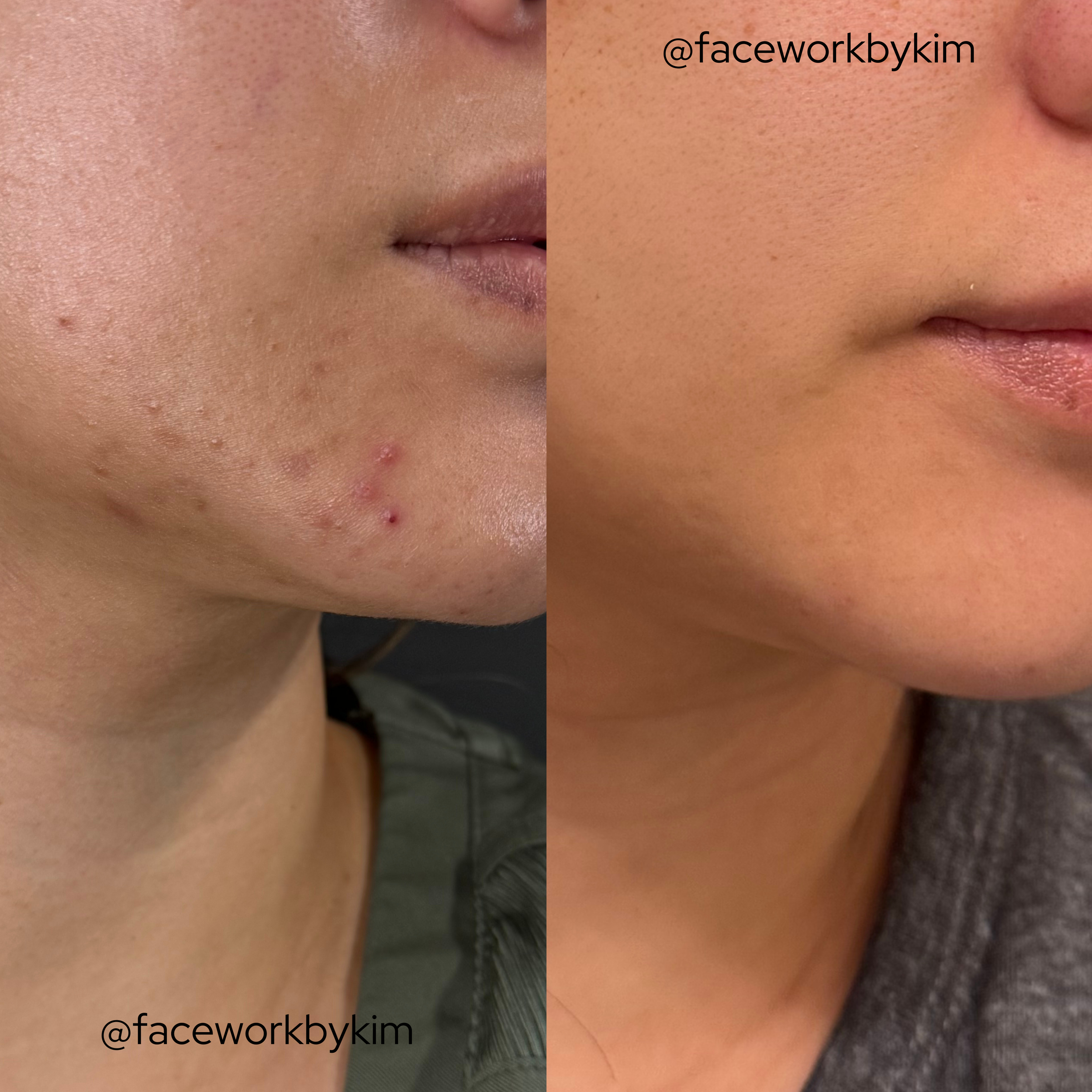 Biweekly treatments for 5 months - Triple Threat Hydrafacials with Oxygen treatments in-between. Home care consisting of Circadia and Epicutis