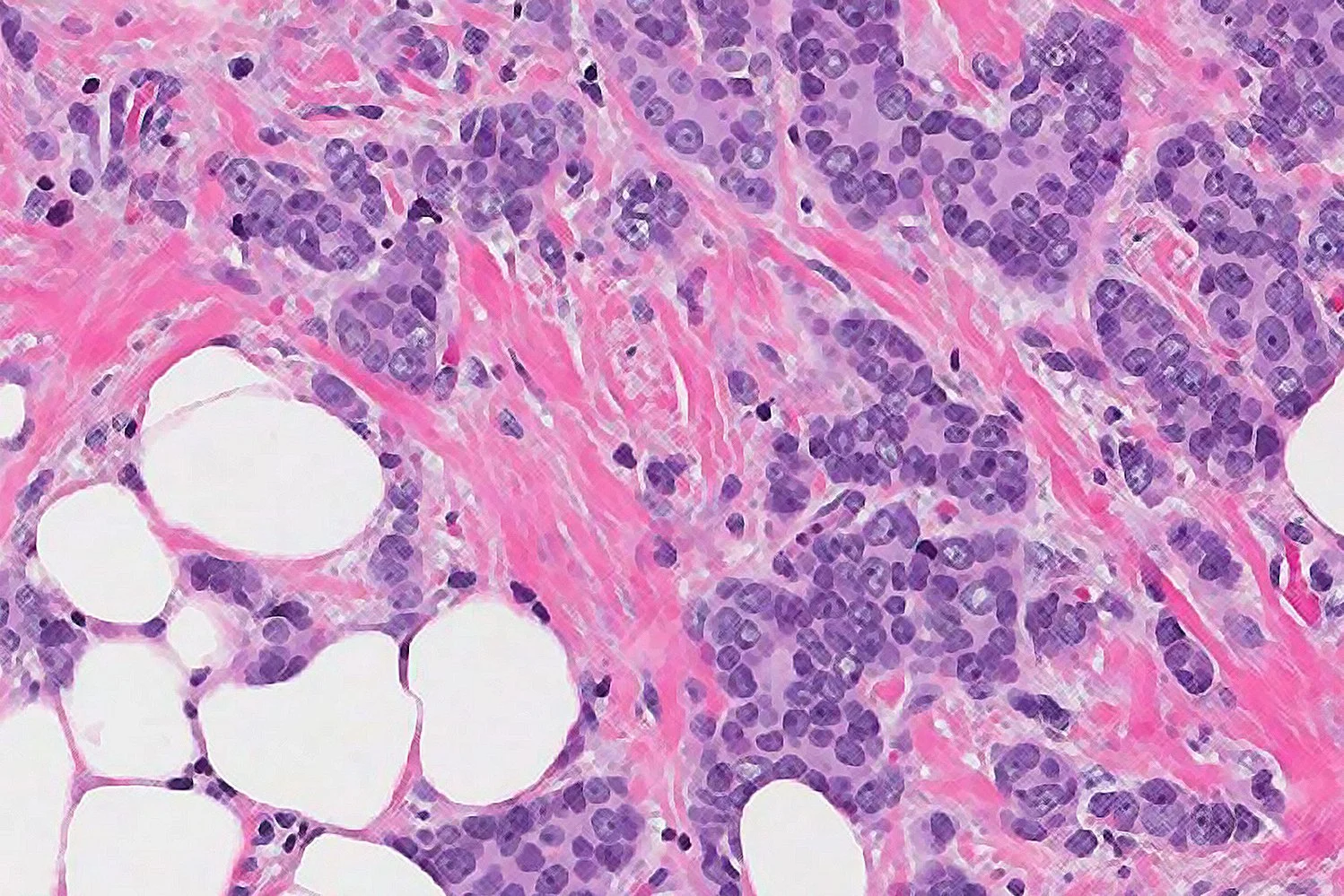 Focus : Vals alarm bij borstkanker