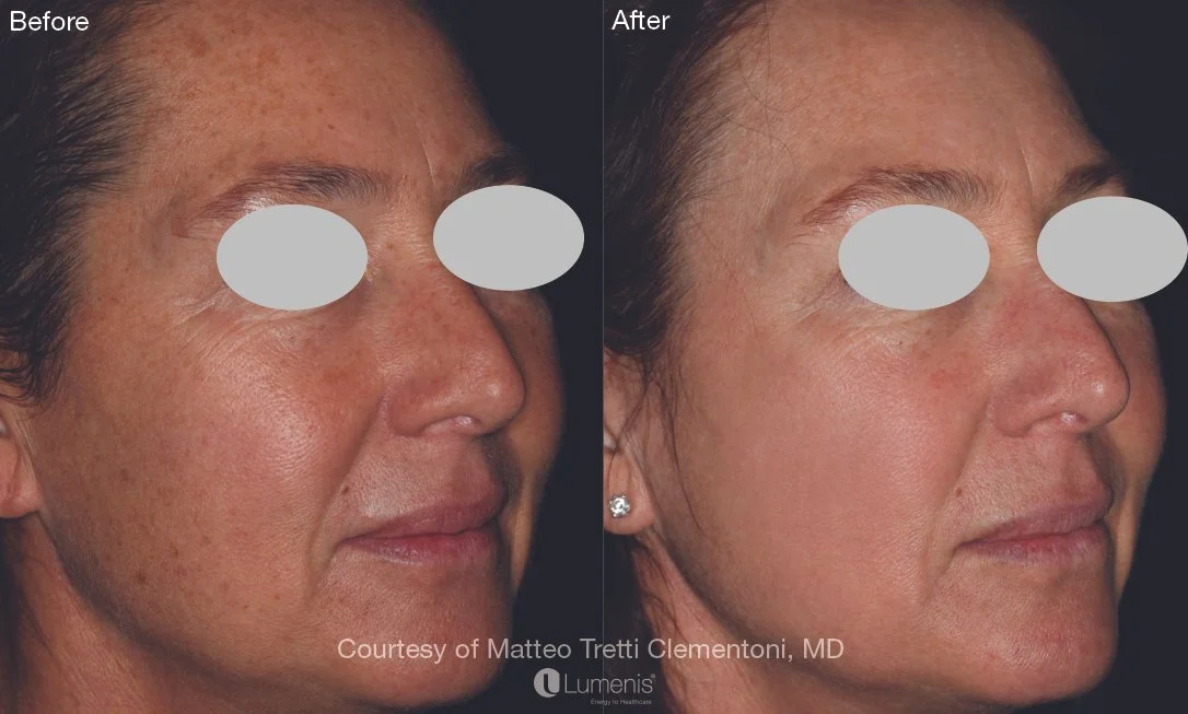 laser resurfacing, antiaging, resurfx south jordan, utah