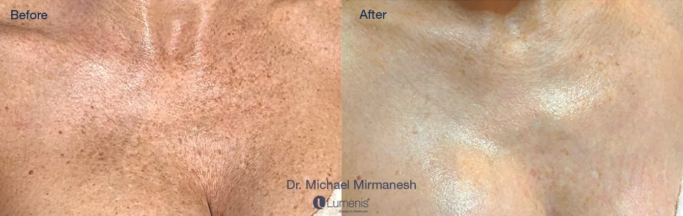 hyperpigmentation, photofacial, south jordan, Utah