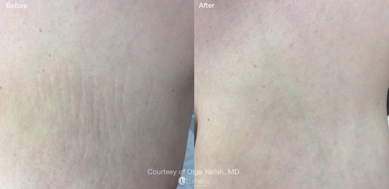 stretch mark removal, laser resurfacing, south jordan utah