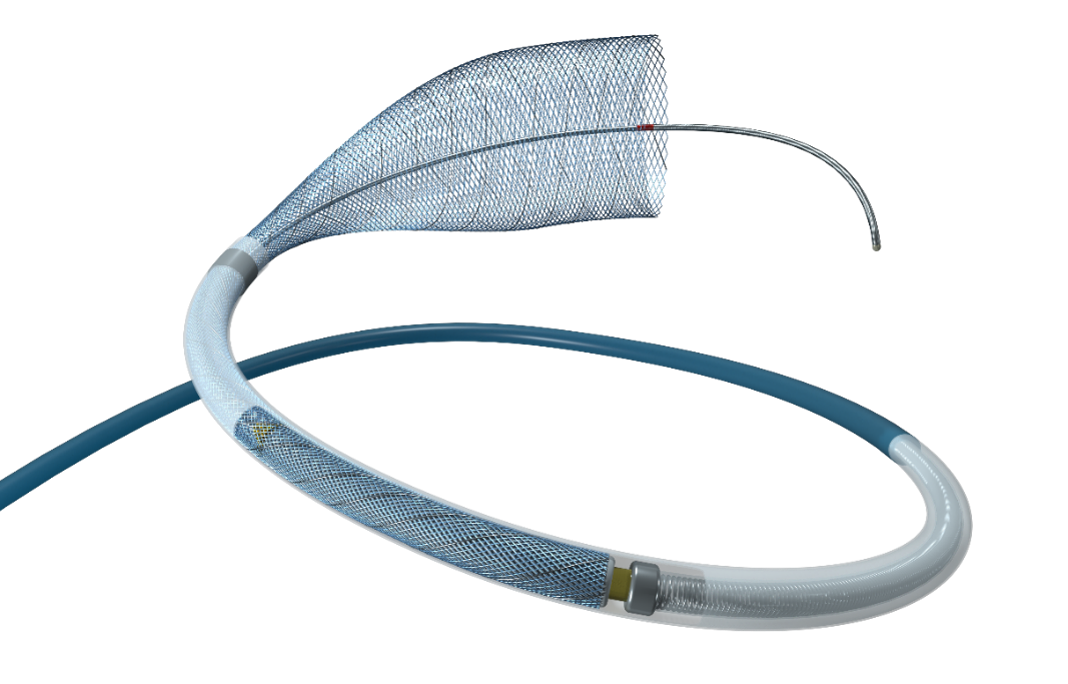 Nuva Flow Diverter: la tecnología de derivación de flujo de TJWY Medical para aneurismas intracraneales