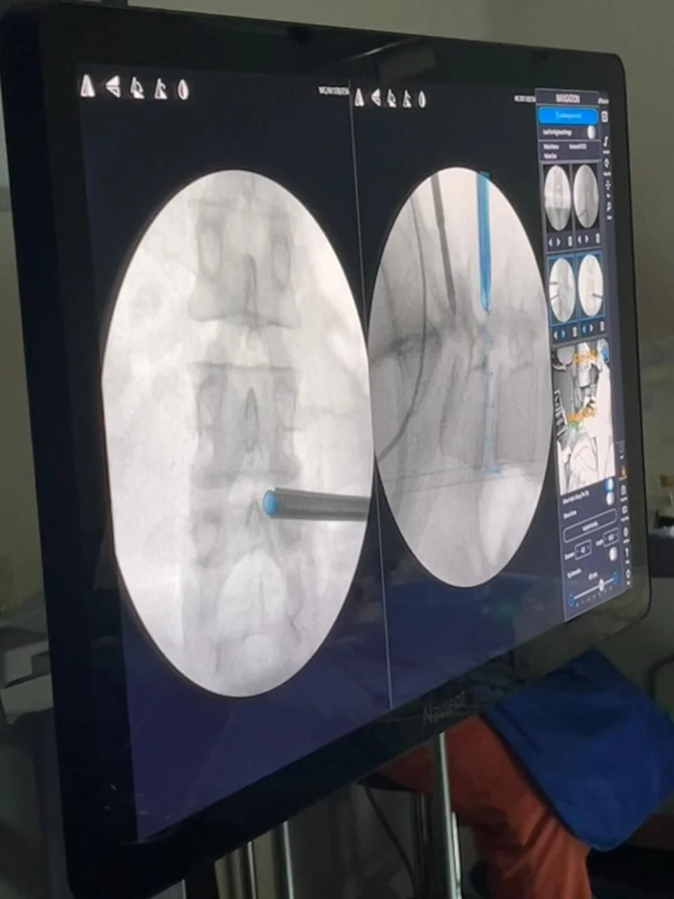 Pantalla del sistema Navient con navegación quirúrgica guiada por imagen para procedimientos de columna