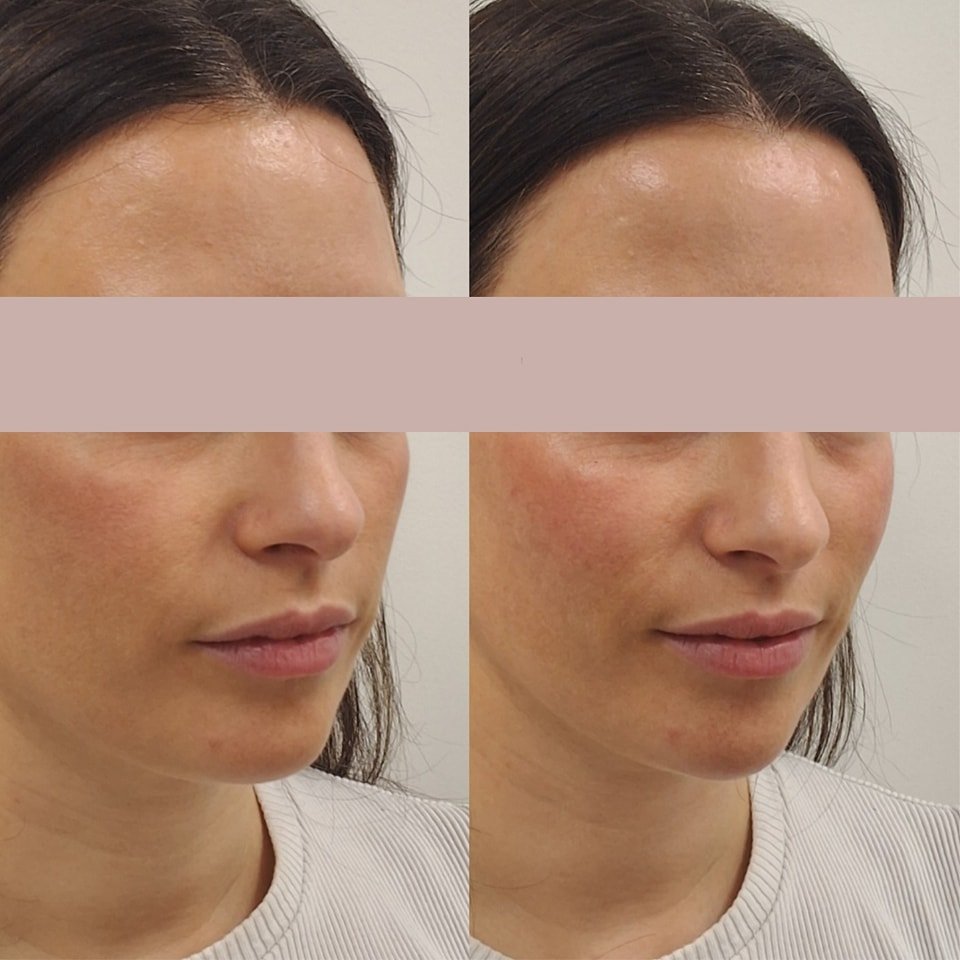 Cheeks and chin for overall harmonisation of the face. 

I love treating the chin - it is an area that is often overlooked, and when treated, it has such an amazing difference to the facial structure and profile balancing 😍