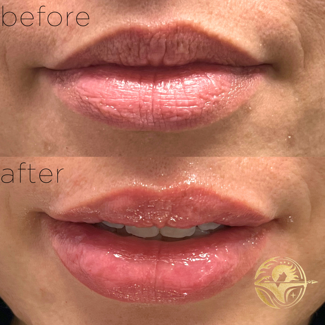 Lip Filler, lip lines only