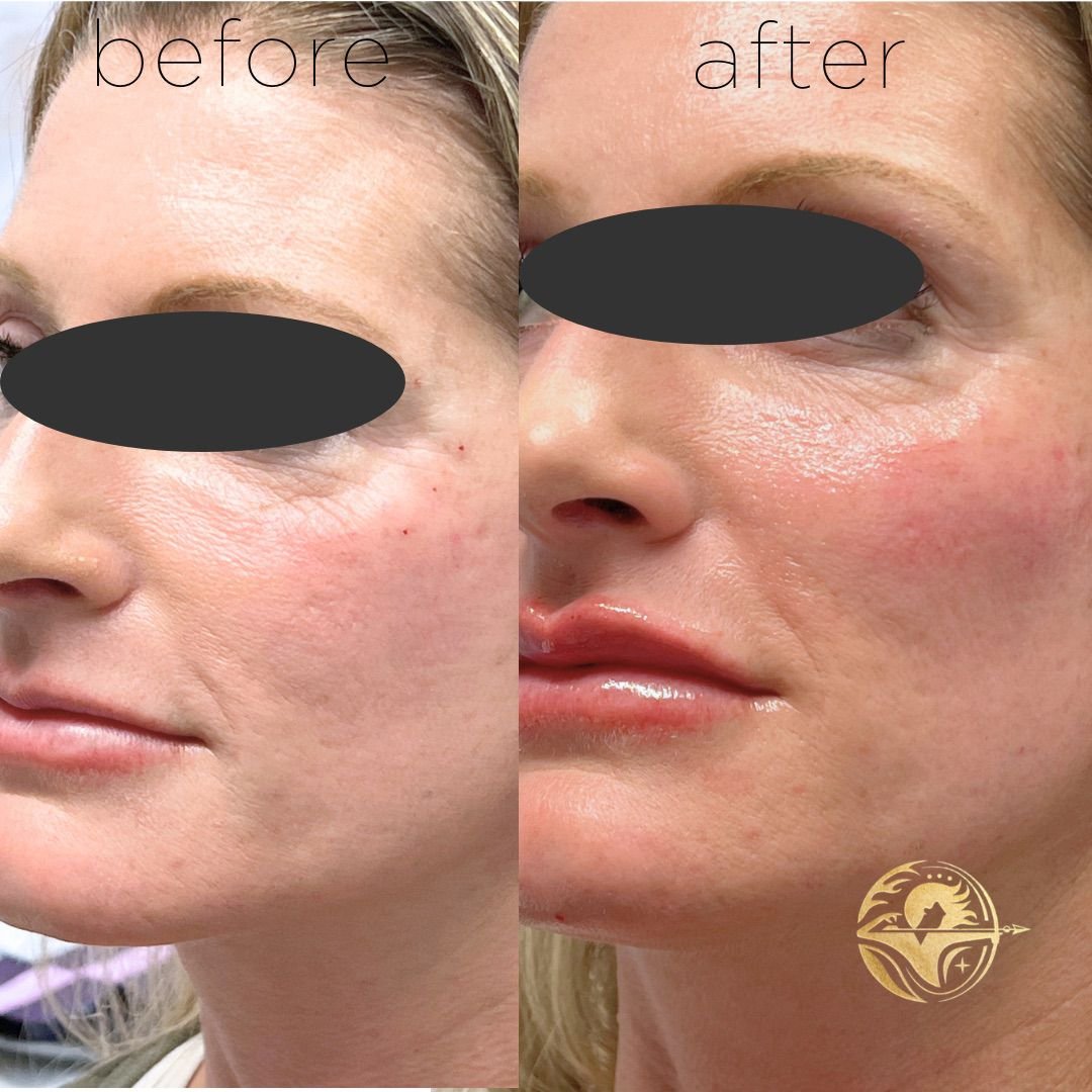 Cheek, Chin and lip filler