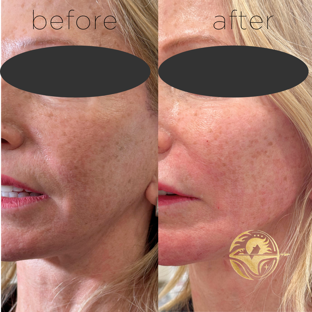 Dermal Filler, Cheeks, Chin, Jawline, Nasolabial folds