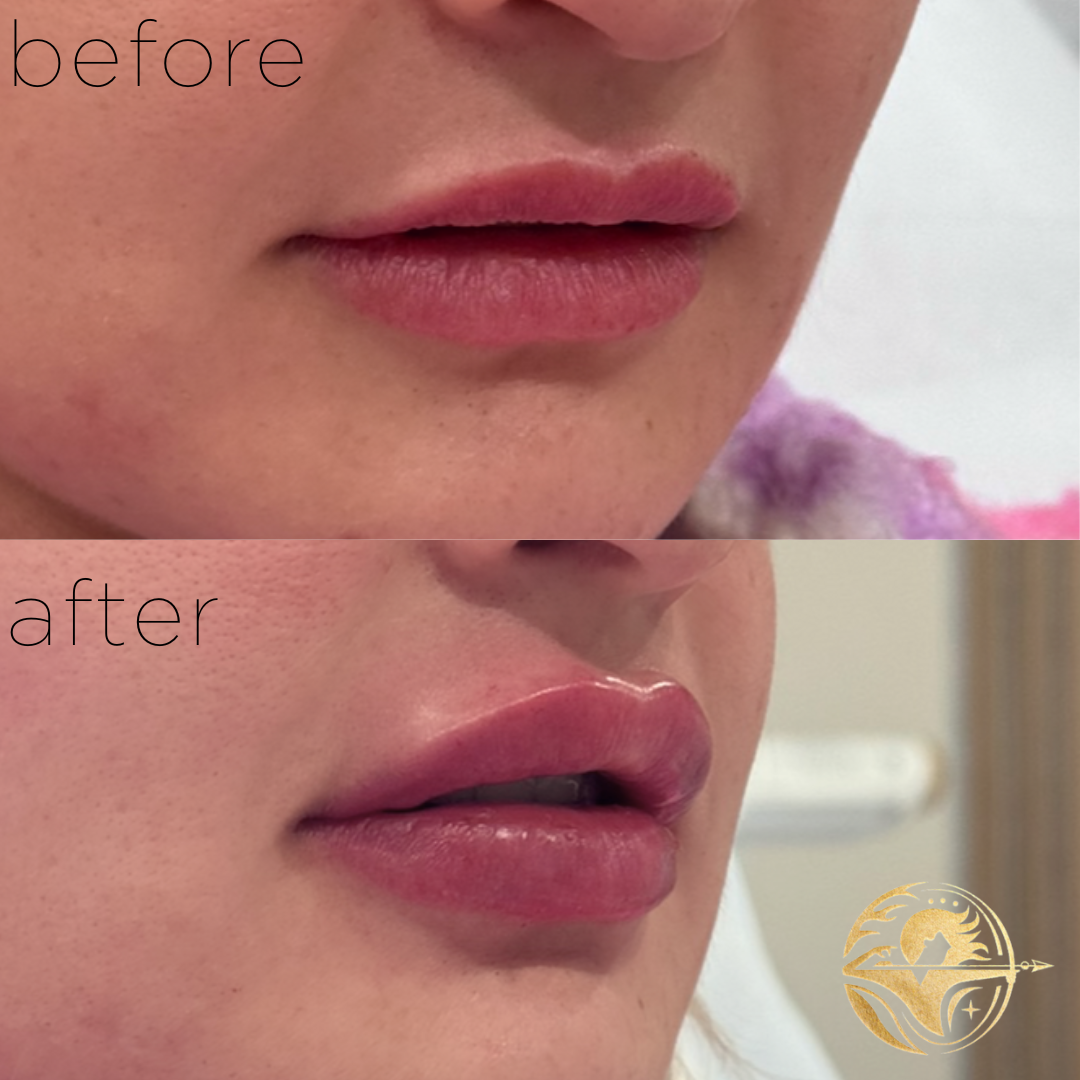 Lip Filler, Volume