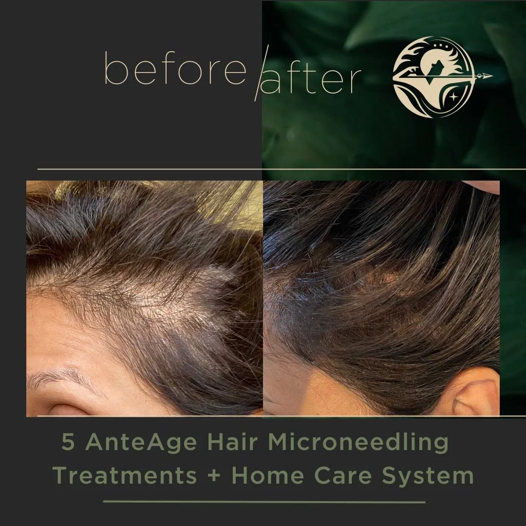 5 AnteAge Hair Microneedling Treatments + Home Care System