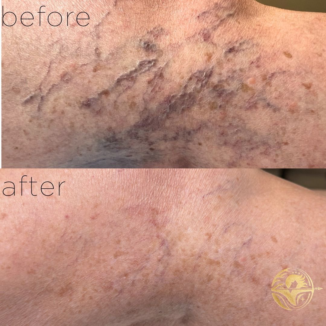 Sclerotherapy, 3 sessions
