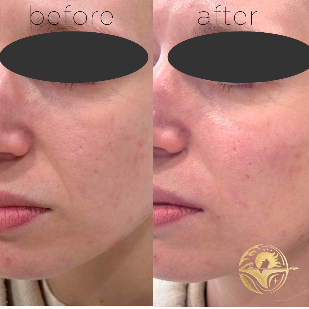 Dermal Filler, Cheeks and nasolabial folds