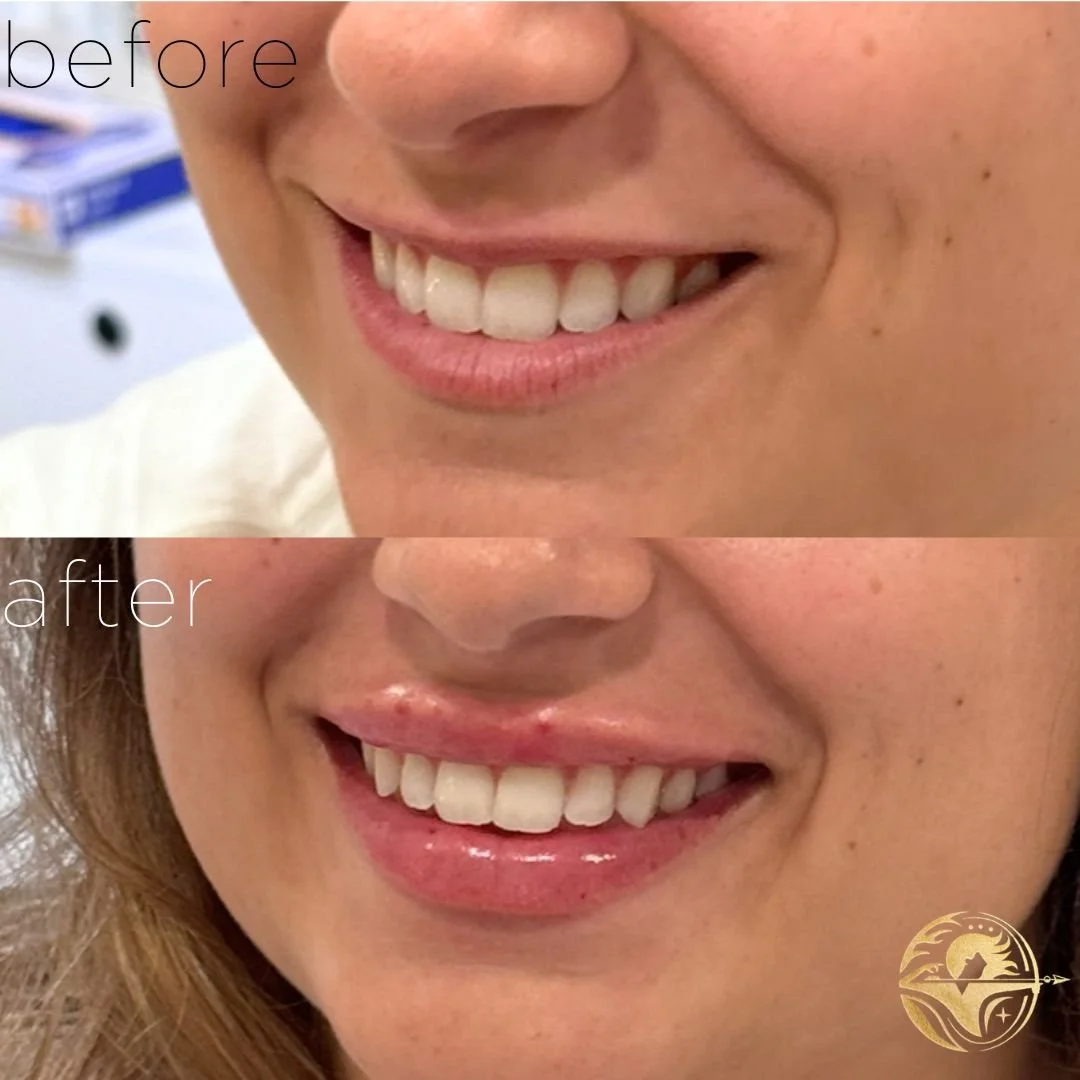 Aphrodites Kiss, 1 ml Lip Filler 