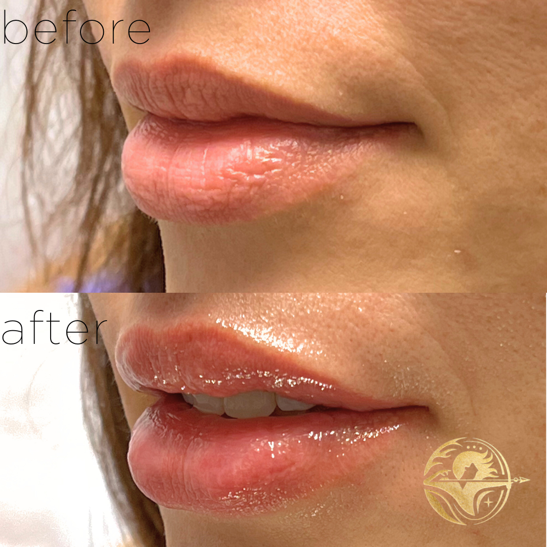 Lip Filler, lip lines only
