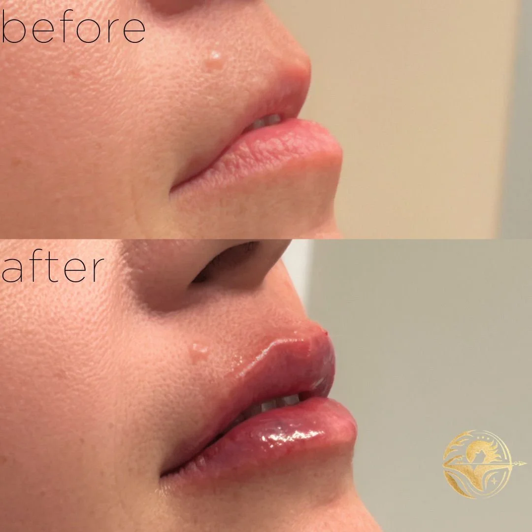 Aphrodites Kiss, 1 ml Lip Filler + Lip Flip 2.jpg