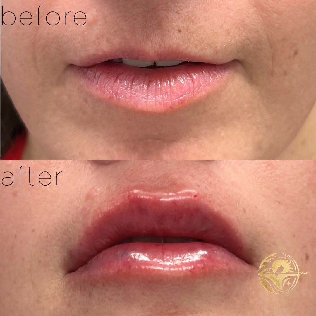 Aphrodites Kiss, 1 ml Lip Filler + Lip Flip 1