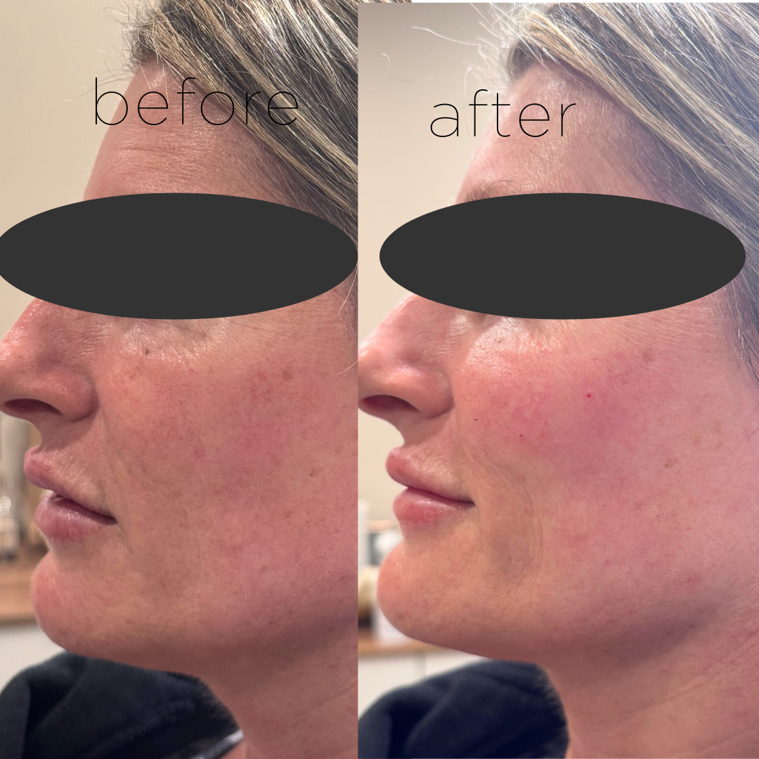 Dermal filler, Cheeks and Chin