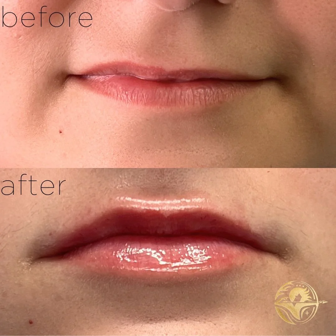 Aphrodites Kiss, 1 ml Lip Filler + Lip Flip