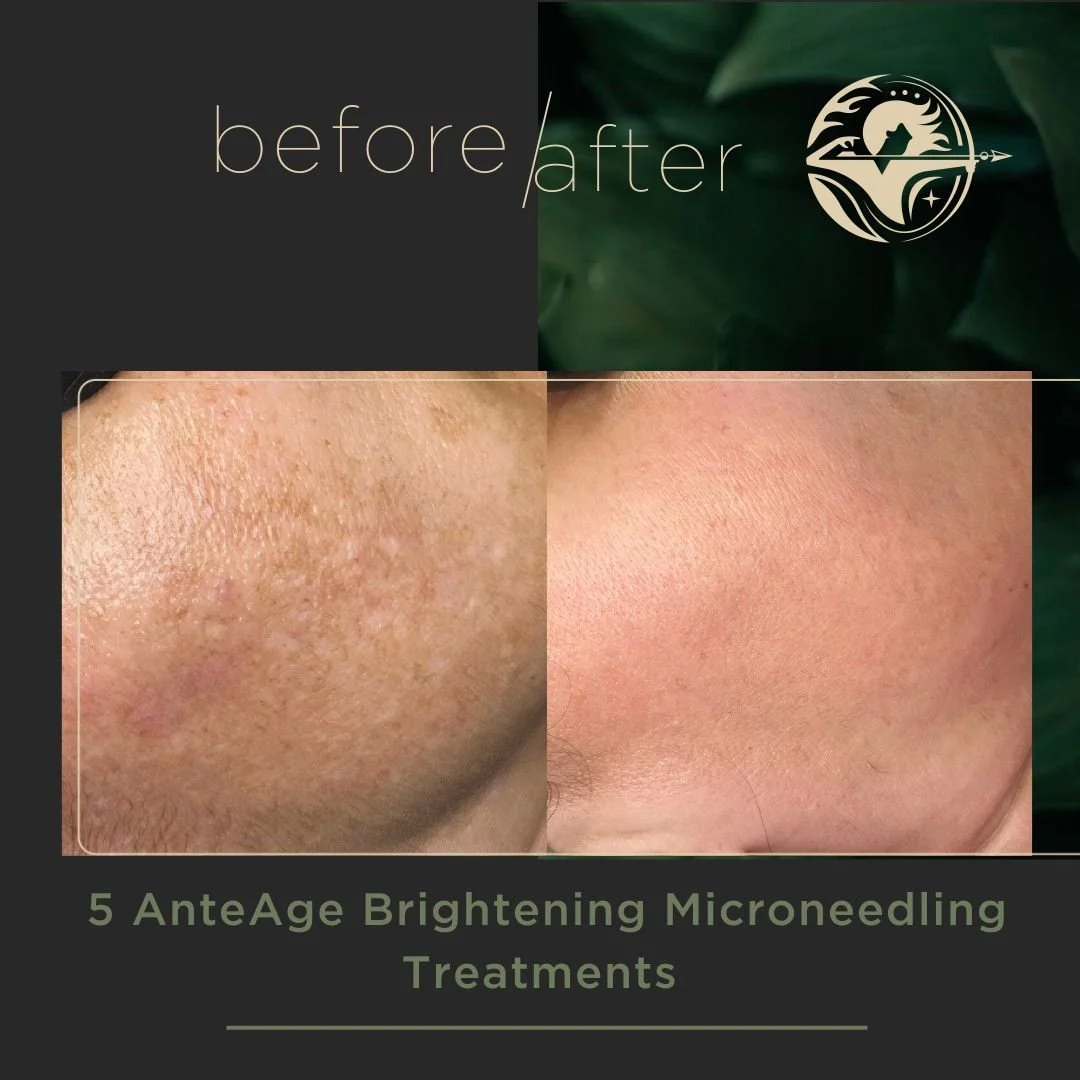 5 AnteAge Brightening Microneedling Treatments