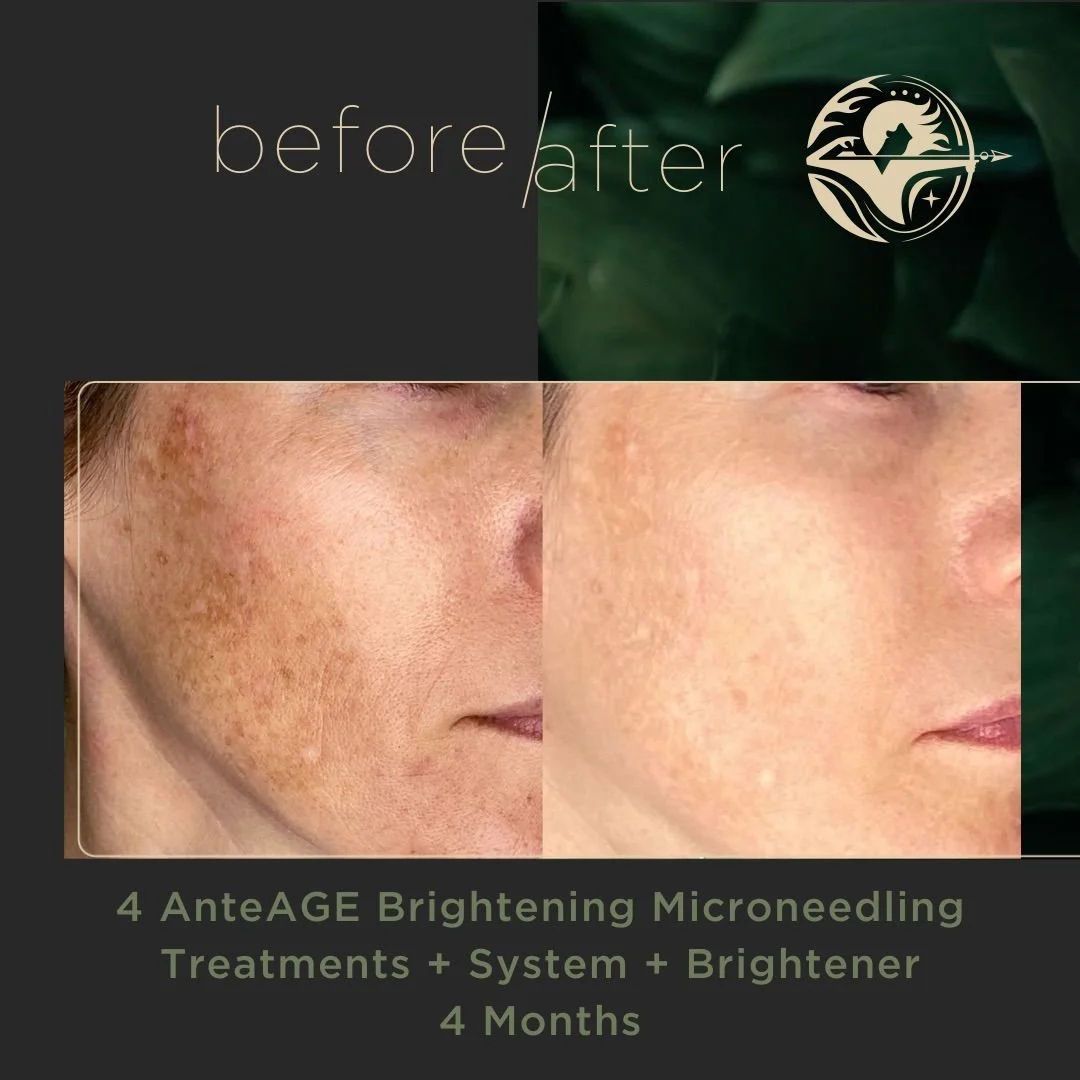 4 AnteAGE Brightening Microneedling Treatments + System + Brightener 4 months