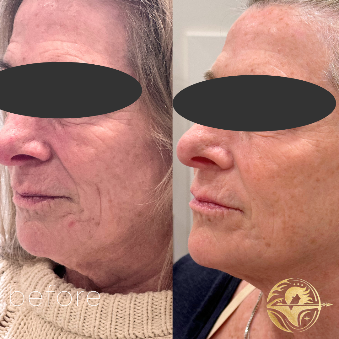 Botox, Dermal Filler cheeks, chin, nasolabial and marionettes, and skincare regimen.
