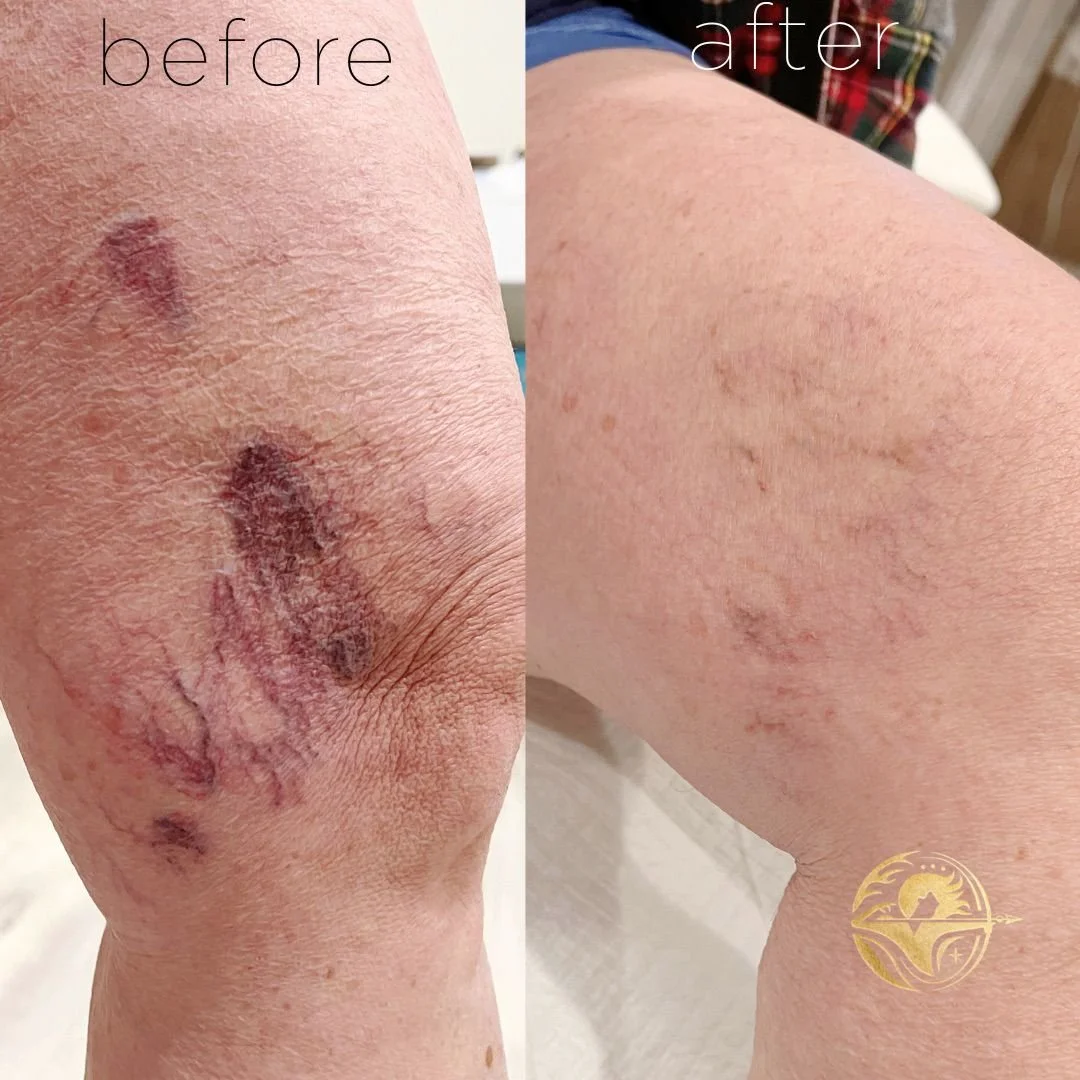 Sclerotherapy, 3 sessions.