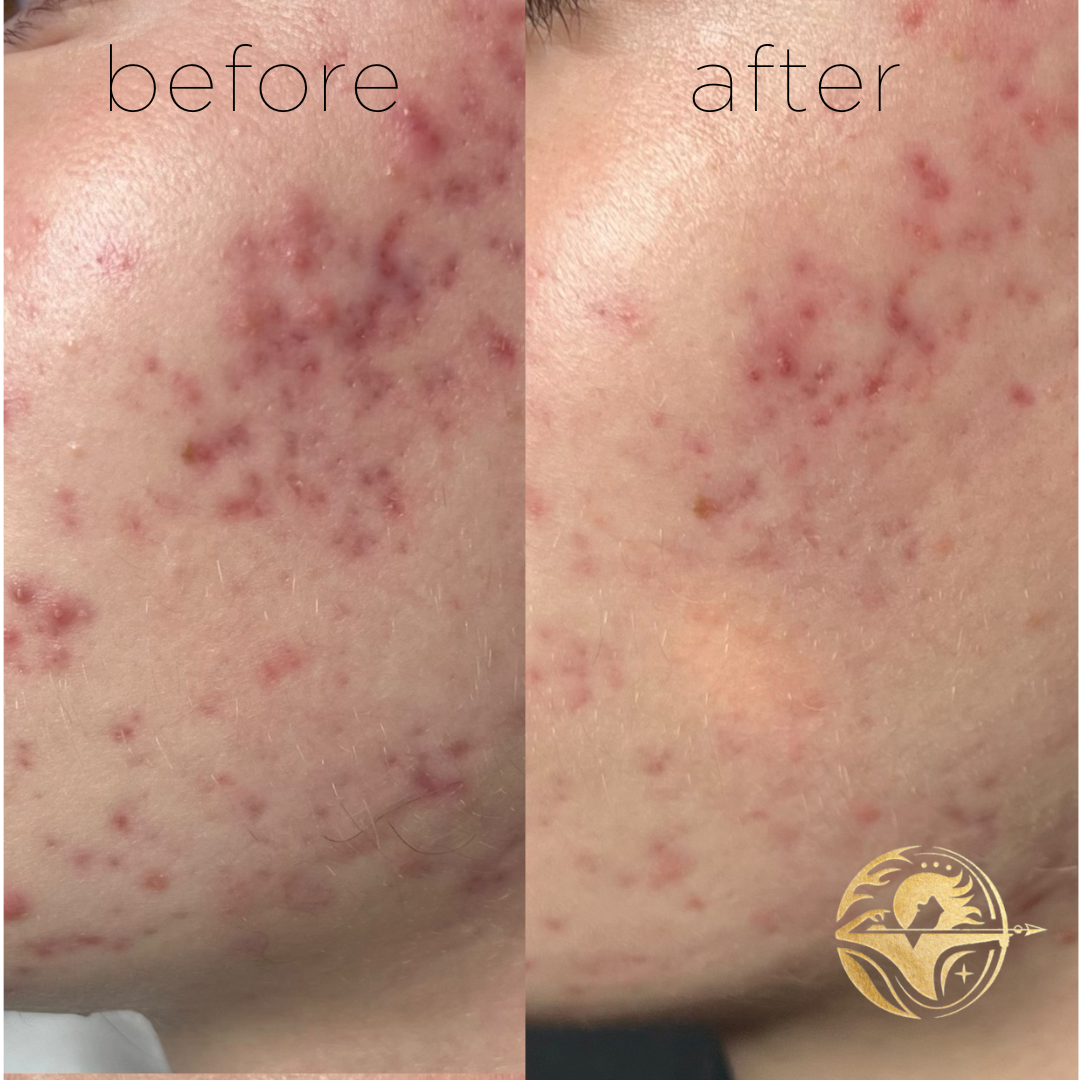 Aerolase NeoClear Acne Treatment, 2 sessions