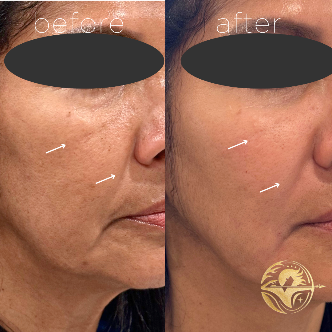 Dermal Filler, Cheeks and nasolabial folds