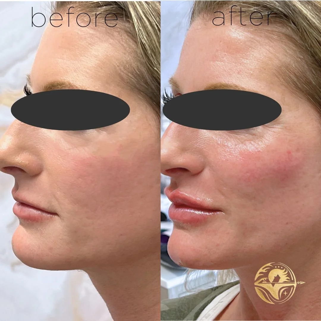 Cheek, Chin and lip filler 