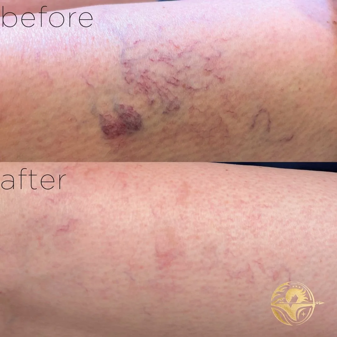 Sclerotherapy, 3 sessions