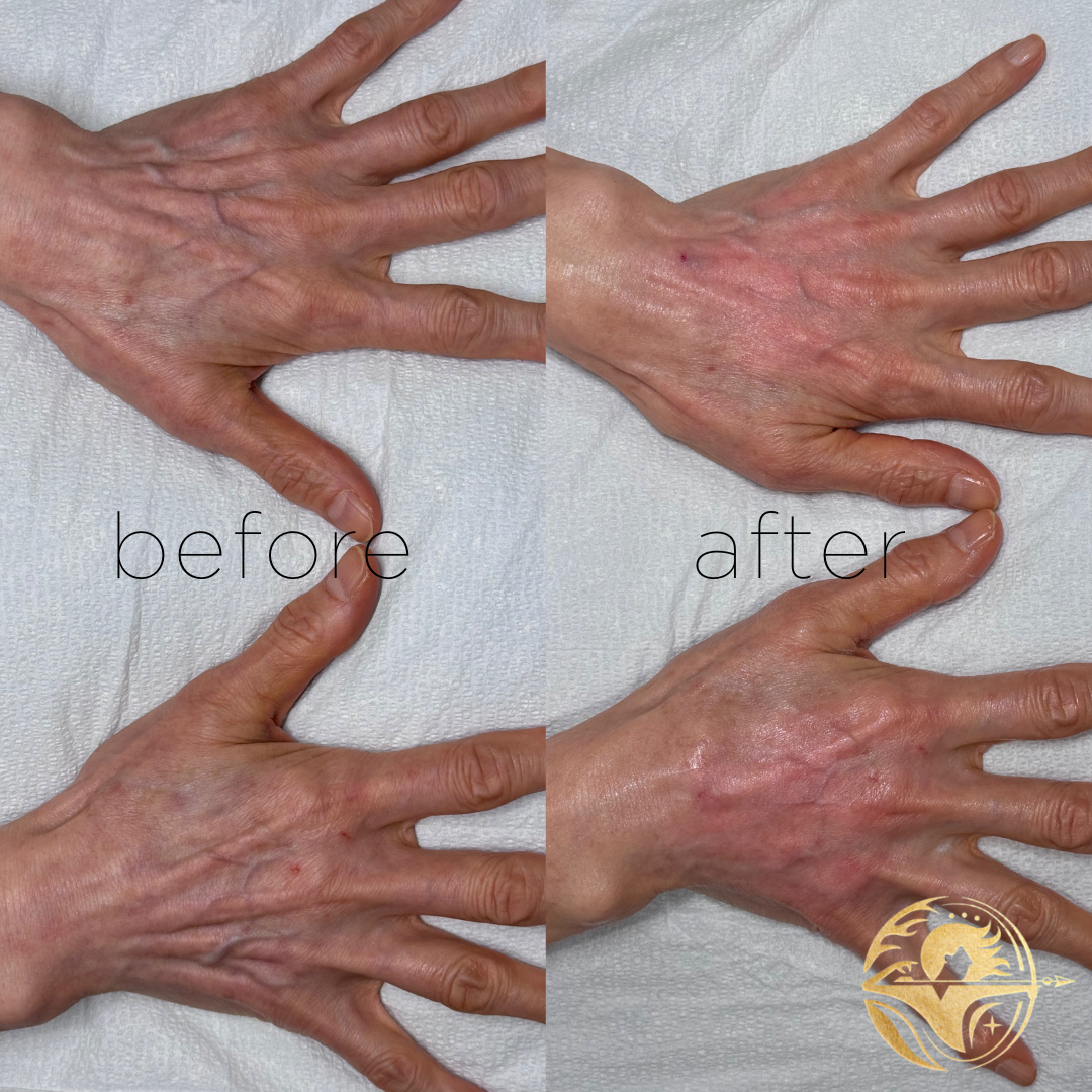 Filler & Biostimulator Hands Treatment