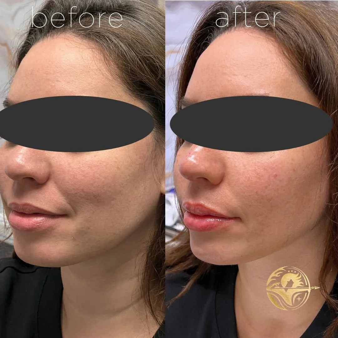 Cheek, Chin, Jawline and Lip Filler