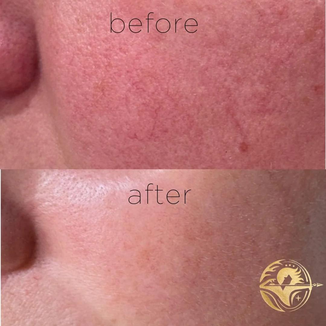Aerolase NeoSkin, Rosacea