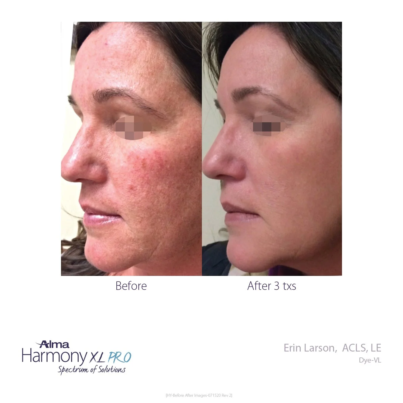 HY-Before_and_After-B2C-04.jpg