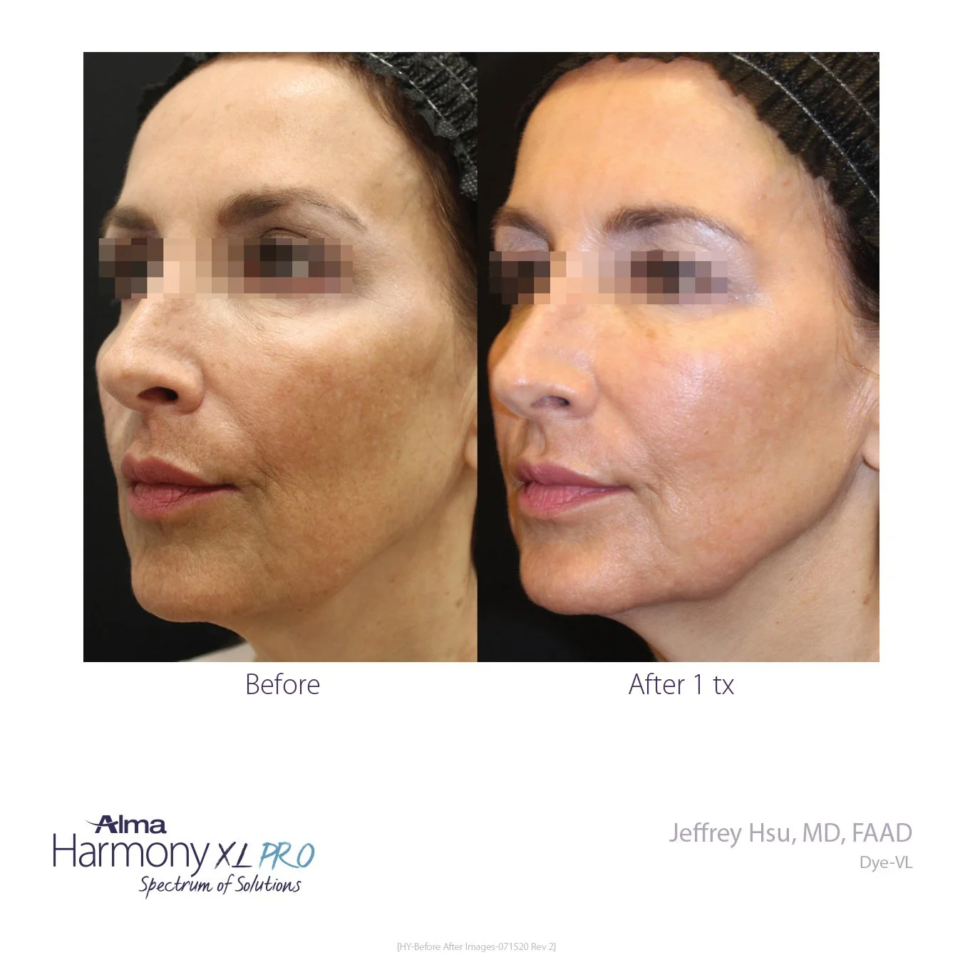 HY-Before_and_After-B2C-08.jpg
