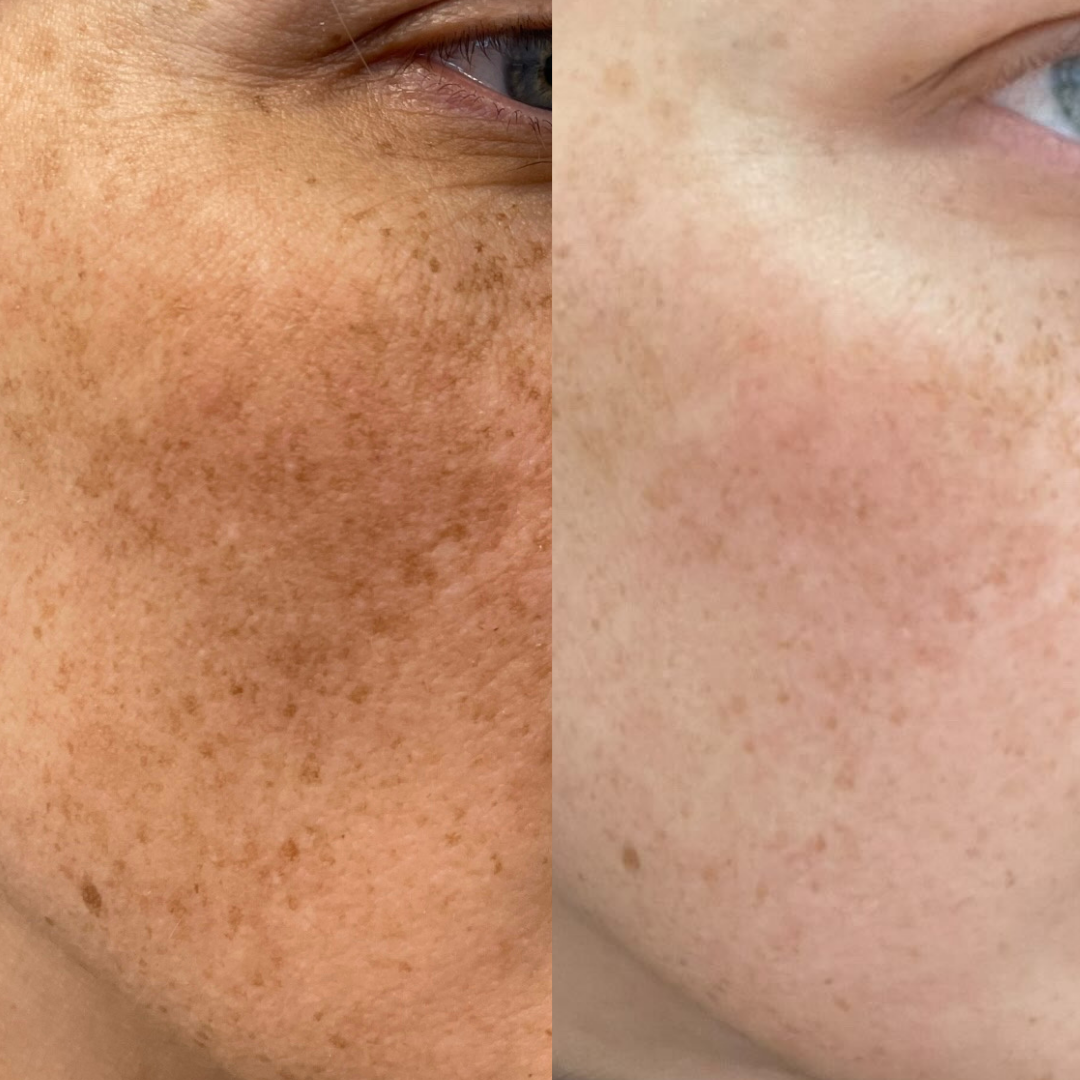Copy of Copy of Copy of Copy of Copy of Copy of Simple Photo Before and After Skincare Instagram Post.png